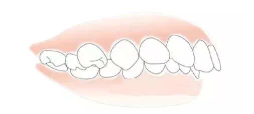 牙齿矫正是怎么做的