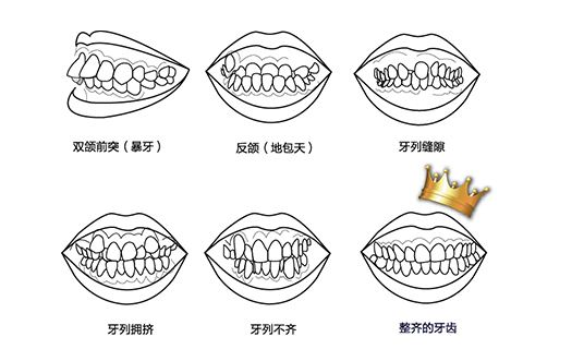 苏州矫正牙齿