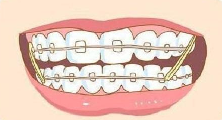 牙齿矫正收缝皮筋图解