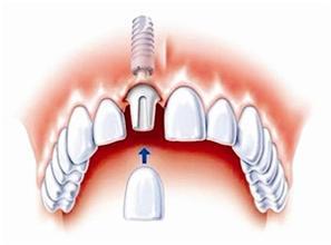 种植牙术后会牙痛的情况的原因你知道吗?