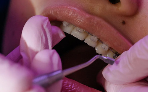 牙齿矫正的方法有哪些5种常见的牙齿整形方法介绍