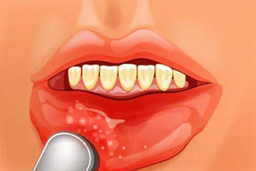 口腔溃疡期间需要注意什么